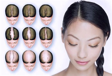 De Belangrijkste Factoren Bij Haartransplantatie