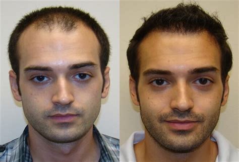 Haartransplantatie Behandeling: Voor En Na Foto's