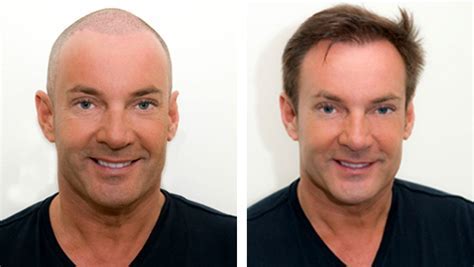 Haartransplantatie En Mode: Zijn Er Trends?