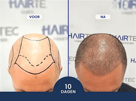 Haartransplantatie En Ouderdom: Wat Zegt De Wetenschap?