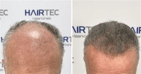 Hoe Lang Duurt De Herstelperiode Na Haartransplantatie?