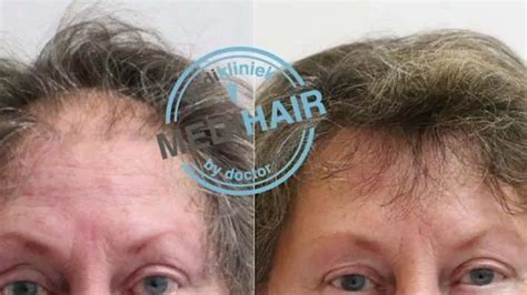 Wat Je Moet Weten Over Haartransplantatie Voor Vrouwen